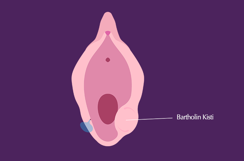 Bartholin Kisti Nedir? Neden Oluşur ve Nasıl Tedavi Edilir?