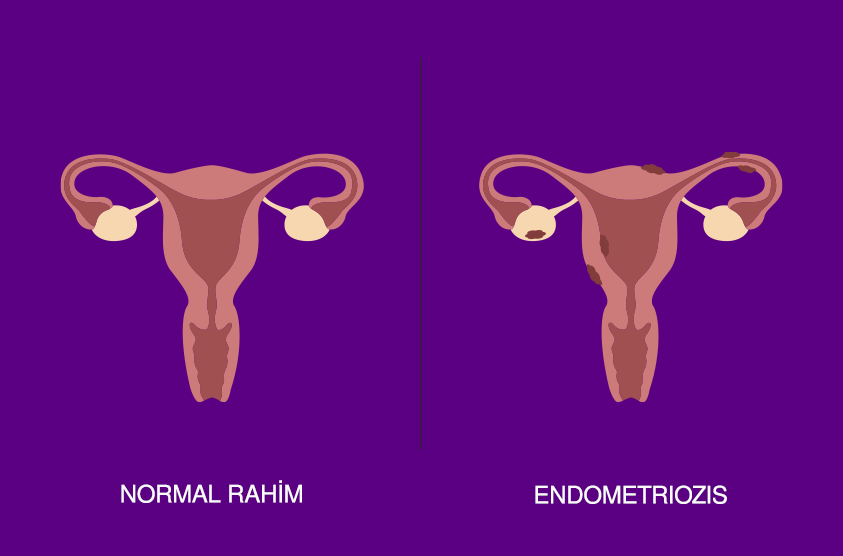 Çikolata Kisti (Endometriozis) Nedir? Ne Zaman Doktora Başvurmalıyım?