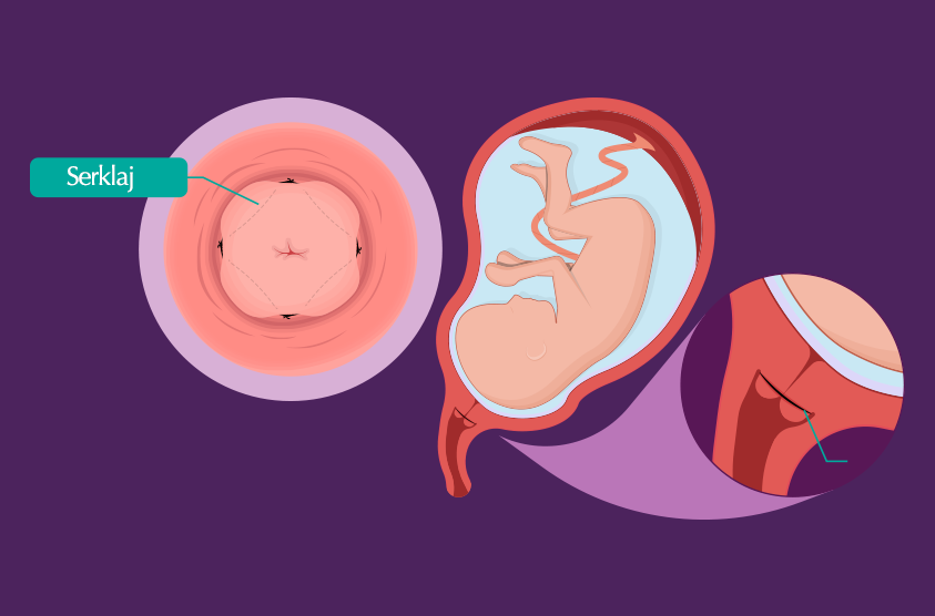 Serklaj Nedir? Hangi Durumlarda Yapılır?